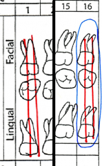 Purposed extractions are charted as two red lines drawn through all aspects of the tooth
If the extraction is an impacted tooth, it is also circled in blue.
