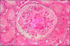 What pathologic changes are demonstrated in this image?


 


What disease is it associated with?