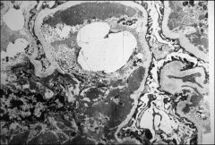 What pathologic changes are demonstrated in this image?


 


What disease is it associated with?
