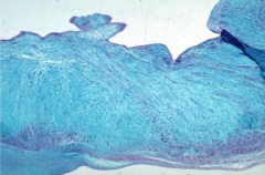 Deposition of mucoid material in valve
(blue = collagen in trichrome stain, indicates lots of ground substance)