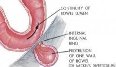 A hernia that involves only part of the bowel wall so that bowel obstruction (and its signs and symptoms) does not occur