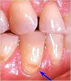 loss of tooth structure caused by tooth grinding, an improper bite, a hard toothbrush or poor brushing technique.