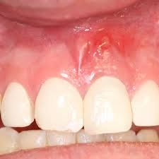 a localized infection of a tooth and/or the gum