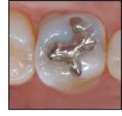 the most common material used for fillings, also called silver fillings
