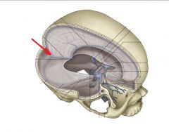 This is an area of the dural venous sinuses where the superior sagittal sinus, straight sinus, & occipital sinus all join. It drains into the right and left transverse sinuses.