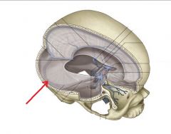 This dural venous sinus begins at the confluence of sinuses and wraps laterally and anteriorly around the brain. It also receives drainage from the superior petrosal sinus. After it curves, its name changes to the sigmoid sinus. One of these is fo...