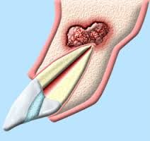 removal of the root end of a tooth to treat an infection