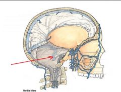 This dural venous sinus is a direct continuation of the transverse sinus. The transverse sinus becomes this after it curves into an "S" shape. It receives drainage from the superior petrosal sinus & runs down to pass through the jugular foramen an...
