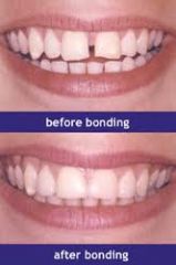 applying a tooth-colored resin to repair and/ or change the color or shape of a tooth, most often the front tooth