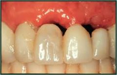decrease in bone supporting the roots of teeth; a common result of gum disease
