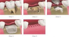the gradual loss of bone Orthodontists use this process to "pull"  teeth through bone to new positions