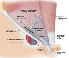 Hesselbach triangle
Inguinal ligament
Rectus muscle
Epigastric artery
