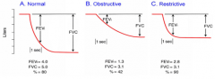 Obstructive: forced expiratory volume is decreased, going slowly into FVC
 
Restrictive: FEV immediately reaches FVC
 
FEV is within first second. FEV/FVC ratio should be 80% rather than 40 or 90.