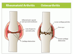 Osteoarthritis
-Common age-related disorder of the synovial joint
-Inflammation of the joint (both)
-loss of articular cartilage, sclerosis of underlying bone, and formation of bone spurs (osteophytes)

Rheumatoid Arthritis
-Inflammatory joint di...