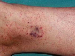 Case 1:
- 18 yo female presents for evaluation of red rash on her bilateral ankles
- Progressively increased over 3 days
- First notice after playing v-ball
- No fever, chills, lymphadenopathy, recent illness or meds
- Last menstrual period w...