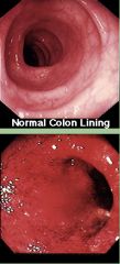 What is wrong with the colon in the picture below the normal colon?