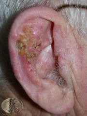An elderly patient presents with irregular scaly plaques of up to several centimetres in diameter, on his ear.
What is this condition?