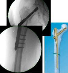 Blood supply maintained ⟹ Preserve neck and head of femurDynamic hip screw – Most common

Intramedullary nail – If DHS unstable (torque in IMN is lower because the axis is not offset)