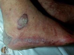 A HIV infected patient presents with a purplish spots on the ankle. Initially, the lesion was small and painless but it then ulcerated and become painful. What is this condition? 