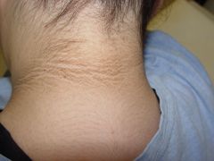Presence of these signs typically suggest inoperable disease:


Signs of stage
Troisier's sign (Virchow's node enlargement on the left)
Epigastric mass

Signs of obstruction
Hepatomegaly
Jaundice 
Ascites


Signs of disrupted growth hormone axis
A...