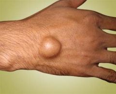 A patient presents with this firm, cystic lump in his wrist. What is the lump?