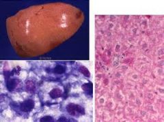 If these were given to you and you were told that these were specimens from a dog with diabetes mellitus, what would you suspect happened in this liver?