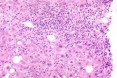 If you looked under a slide and saw this, what disease would you suspect going on in the liver?