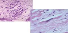Aschoff Body: 
- Foci of swollen eosinophilic collagen
- Surrounded by T cells, plasma cells, and macrophages
- Macrophages are plump - aka Anitschkow cells or caterpillar cells