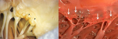 Fibrinoid necrosis and verrucae along lines of closure of valve cusps