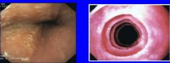 What endoscopic findings can be seen in these images?


What disease/ disorder are these findings consistent with?