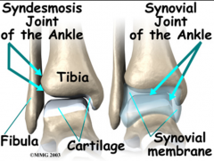 An immovable joint in which bones are joined by connective tissue (e.g. between the fibula and tibia at the ankle)