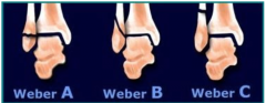 Weber classification (based on level of fibula #)
Weber A – # distal to syndesmosis
Weber B – # at syndesmosis
Weber C – # above syndesmosis