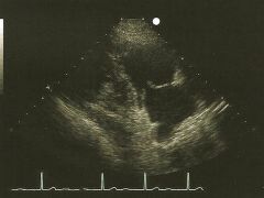 PLAX RVIT (Parasternal Long Axis view of the Right Ventricular Inflow Tract)