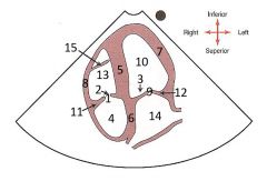 What heart valve is represented by 1?