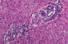 This is a histological example of what developmental anomaly in the liver?