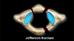 Jefferson fracture – Burst at C1 due to axial loading 
