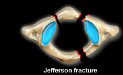 Burst fracture of C1 caused by
direct axial loading i.e. diving into shallow water