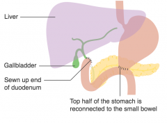 Afferent loop syndrome, a complication of some gastrectomy (depending on approach)

The afferent loop fills with bile after the meal