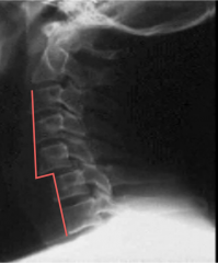 Unifacet dislocation/subluxation (one vertebra dislocating anteriorly to its inferior neighbor) 

Unifacet demonstrates < 50% displacement while bifacet demonstrates > 50% displacement