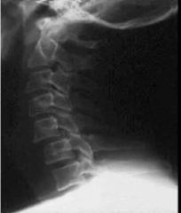 A patient underwent flexion distraction injury and rapidly develops neurology. X-ray is displayed. Likely diagnosis?