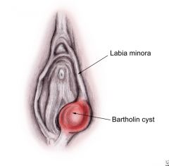 bartholin cyst location