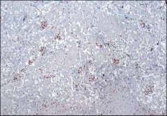 if this is rhabdoid tumor what is the ihc