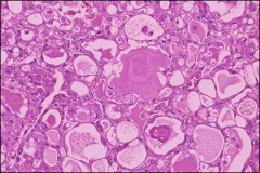 what, patient population, histology, histochemical staining