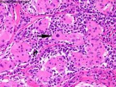 Hurthle cells are large polygonal follicular cells with granular cytoplasm; may indicate underlying Hurthle cell adenoma or Hurthle cell carcinoma. Hurthle cells may also be present as metaplastic cells in a variety of thyroid disorders, such as m...