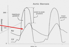 - Pressure in ventricle highly exceeds pressure in aorta
- This means that the aortic valve is limiting the transfer of pressure from LV to aorta