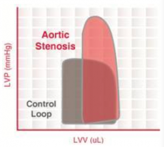 - Ventricle is squeezing, but volume is staying the same valve is stenosed
- Causes increase in pressure above normal
- Eventually pressure in ventricle exceeds pressure in aorta and some blood gets out
- There is a smaller stroke volume