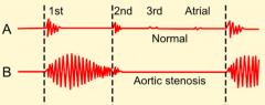 - Absent A2 or paradoxically split A2
- Systolic murmur with crescendo decrescendo