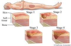 Stage I - Erythema of intact skin (reddening of the skin)
Stage II - Partial-thickness skin loss, involving the epidermis or dermis
Stage III - Full-thickness skin loss, involving damage or loss of the subcutaneous tissue
Stage IV - Full-thicknes...