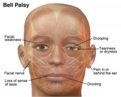 Bell's palsy

(1) wrinkling th forehead, 
(2) closing the eye tightly,
(3) smiling

Anterior 2/3 of tongue