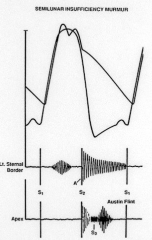 - Widened pulse pressures
- Diffuse and displaced Point of Maximal Impulse (PMI)
- Diastolic murmur (diastolic decrescendo murmur as they lean forward and exhale)

- De Musset's sign: head bobbing
- Muller's sign: bobbing uvula
- Quinicke's ...